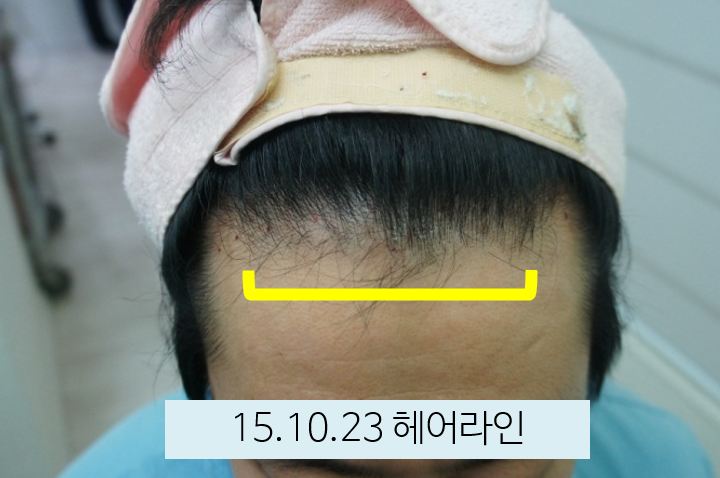 시술 후