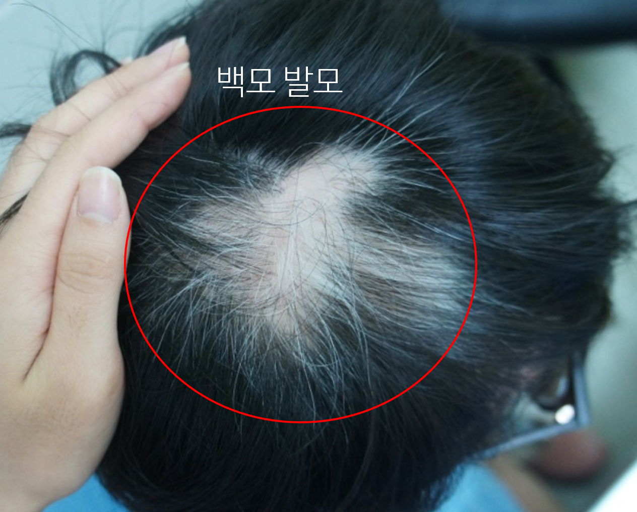 시술 후