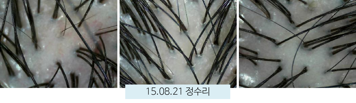 시술 후