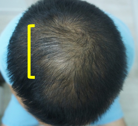 시술 후