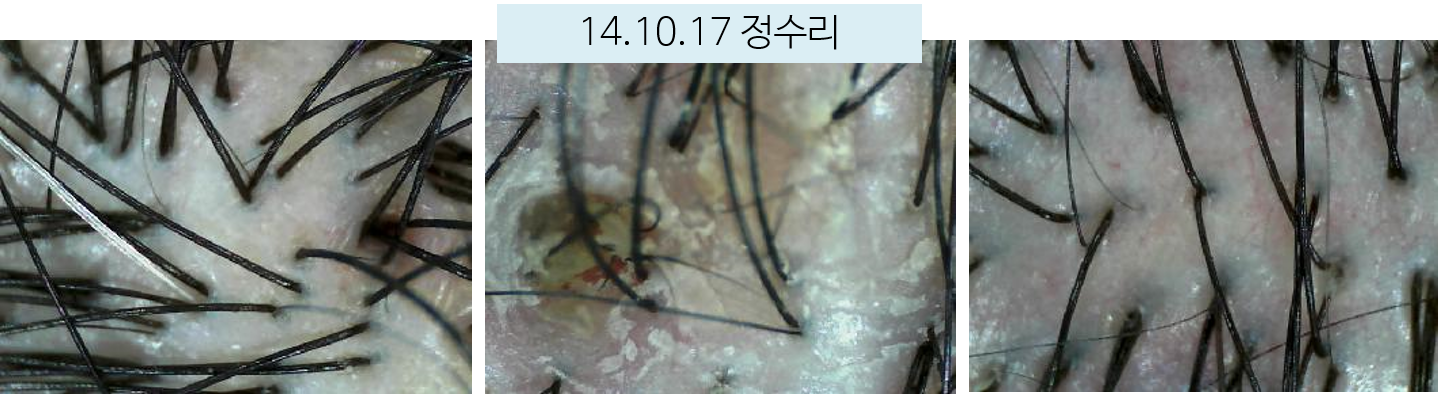 시술 전